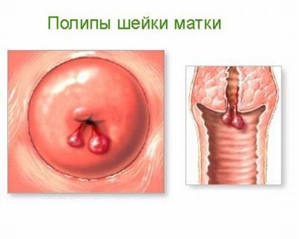 - cauzele polipului cervical, simptomele și tratamentul fără intervenții chirurgicale, felomena