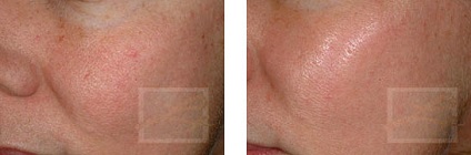 Lipirea superficială a feței retinoice