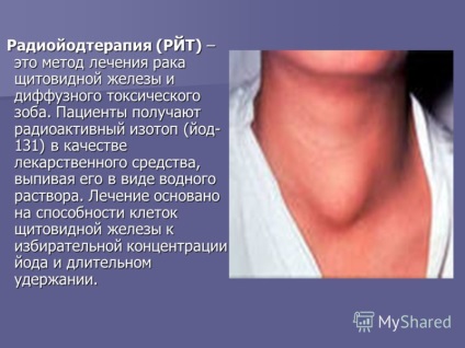 Prezentarea pe tema tratamentului glandei tiroide a tumorilor cu autorii iodului radioactiv Kononova, boiarsky