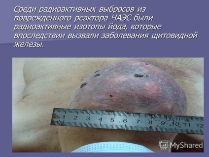Представяне на щитовидната тумор на лечение с радиоактивен йод автори Кононов, Boyarskii