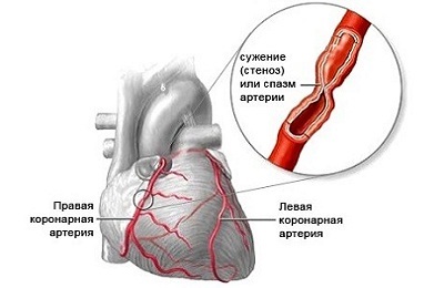 Scăderea simptomelor cardiace, cauzele și tratamentul