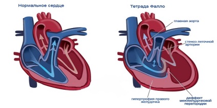 Scăderea simptomelor cardiace, cauzele și tratamentul