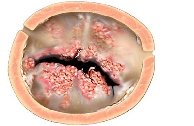 Придбані пороки серця симптоми, причини і лікування