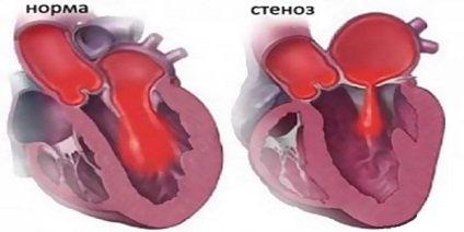 Scăderea simptomelor cardiace, cauzele și tratamentul