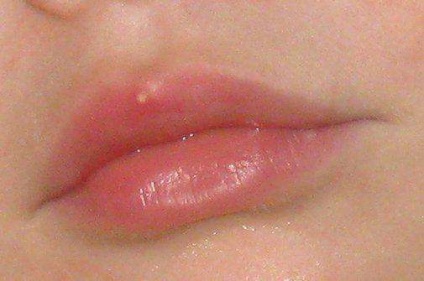 Pimples pe buza cauzei apariției și a metodelor de tratament