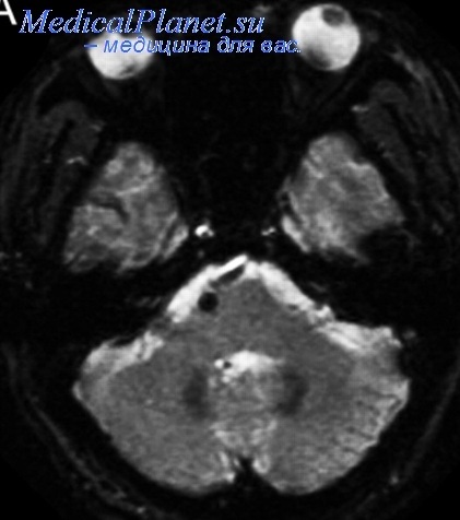 Prevenirea accidentului vascular cerebral