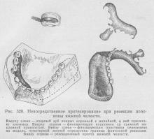 Proteza după rezecția jumătății maxilarului inferior, stomatologia ortopedică