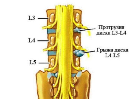Proeminența discului 14 ce este, simptomele, tratamentul
