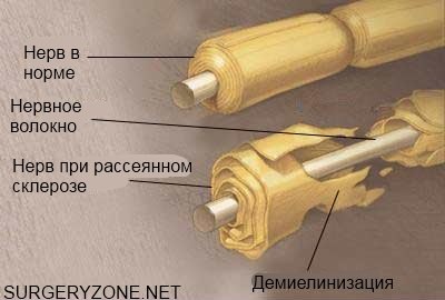 Scleroza multiplă - cauze, simptome, diagnostic, tratament - informații despre neurologie