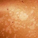 lishay- tünetek többszínű (pityriasis) többszínű lichen - diagnózis és a kezelés