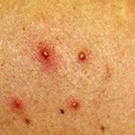 lishay- tünetek többszínű (pityriasis) többszínű lichen - diagnózis és a kezelés