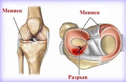 Ruperea tratamentului meniscului articulației genunchiului fără intervenție chirurgicală și restaurarea genunchiului
