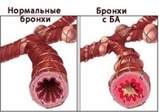 Răspuns la frig cu astm bronșic