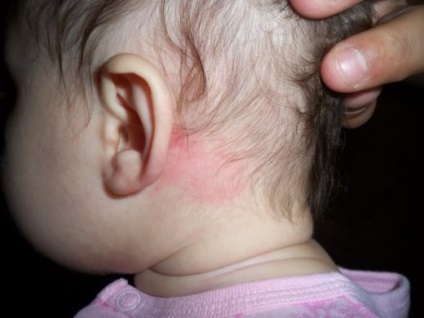 Dermatita seboreică la copii, copii și nou-născuți și simptome, totul despre alergii