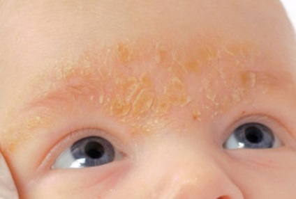 Dermatita seboreică la copii, copii și nou-născuți și simptome, totul despre alergii