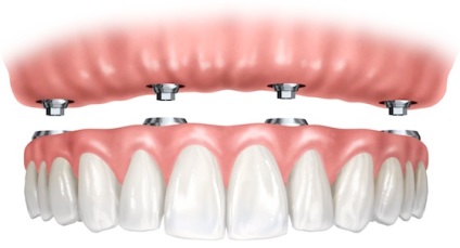 Protecții dentare - prețul, durata de viață, fabricarea protezelor dentare complet și parțial detașabile