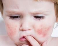 Simptomele și tratamentul edemului Quincke la copii și adulți