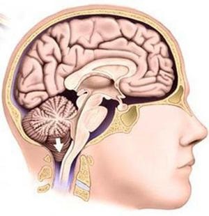 Синдром на Arnold Chiari Какво е опасно, причинява на, симптоми и лечение
