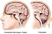 Sindromul Arnold Chiari cauzează, simptome, tratament