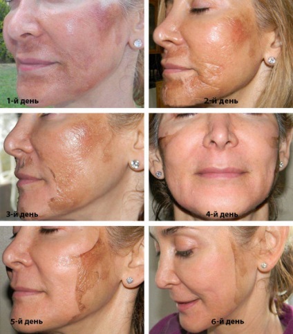 Medián peeling arc típus, a protokoll, a gyógyszerek mellékhatásai