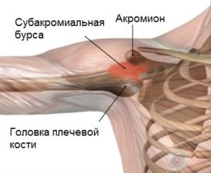 Bursita subacromială a tratamentului articulației umărului (sub-deltoid), uzi