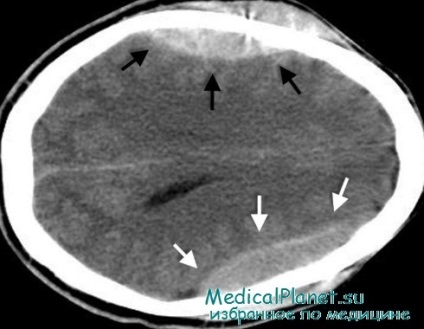 Hemoragia subarahnoidă (sak) la nou-născuți, diagnostic, tratament