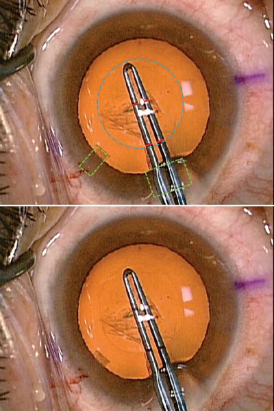 Tehnica capsulorhexisului