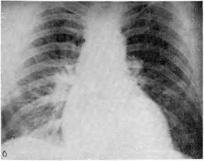 Întunericul total și subtotal - sindroamele cu raze X și diagnosticul bolilor pulmonare