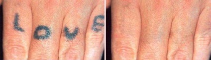 Eltávolítása tetoválás és a tetoválás