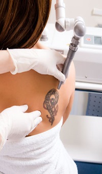 Eltávolítása tetoválás és tartós smink, az ár a tetoválás eltávolítása ülésén a szépségszalonban