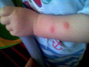 Mosquito mușcături