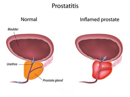 Exerciții pentru prostatită și adenom de prostată la bărbați