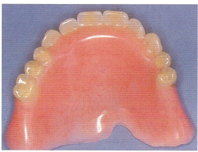 Opțiuni de restaurare a maxilarului fără dinți cu implanturi protetice detașabile