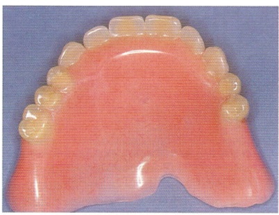 Lehetőségek helyreállítása fogatlan állcsont segítségével fogsor implantátum