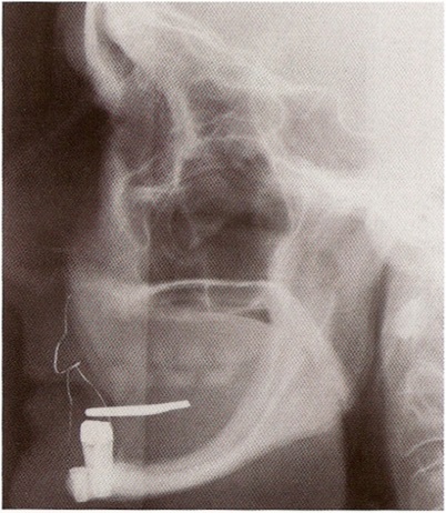 Lehetőségek helyreállítása fogatlan állcsont segítségével fogsor implantátum