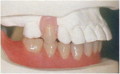 Lehetőségek helyreállítása fogatlan állcsont segítségével fogsor implantátum