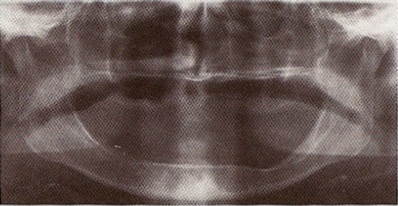 Lehetőségek helyreállítása fogatlan állcsont segítségével fogsor implantátum