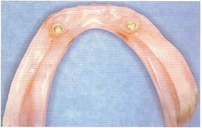 Lehetőségek helyreállítása fogatlan állcsont segítségével fogsor implantátum