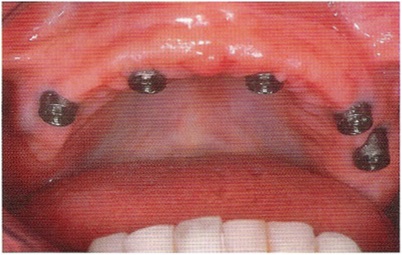 Lehetőségek helyreállítása fogatlan állcsont segítségével fogsor implantátum