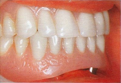 Lehetőségek helyreállítása fogatlan állcsont segítségével fogsor implantátum