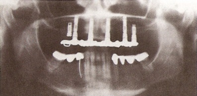 Lehetőségek helyreállítása fogatlan állcsont segítségével fogsor implantátum