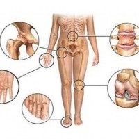 Interconectarea bolilor articulațiilor și a inimii, articulațiile rănit