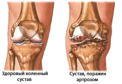 Chondroprotectori pentru revizii de artrită