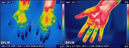 Importanța aplicării imaginilor termice în domeniul medicinii