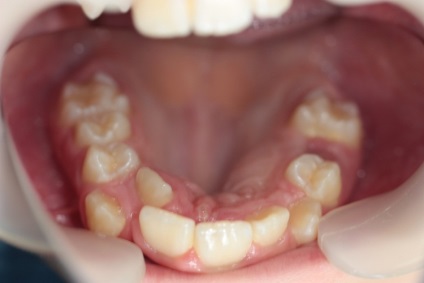 A fogak száma a fogászatban - egy fotó és leírás