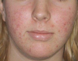 Acnee vulgaris (acnee vulgaris), acnee, acnee pe față, pe spate etc.