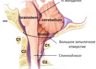 Anomalii ale gradului și tipurilor de arnold-kiari, simptome și semne, diagnostic, mrt-picture, tratament,