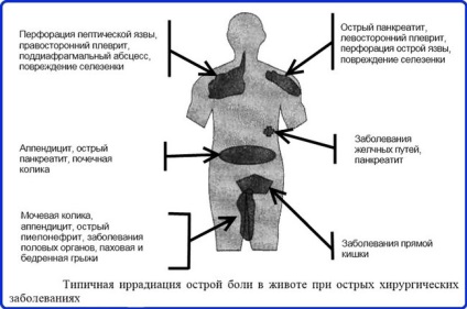 Simptome apendiculare - paturi pentru prim ajutor