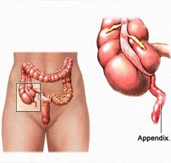 Simptome apendiculare - paturi pentru prim ajutor