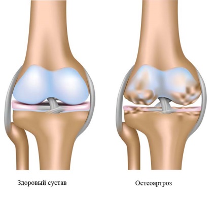 Osteoartrita articulației genunchiului, tratament la domiciliu fără medicamente